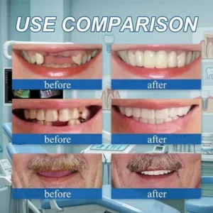 🌎Ends Today: 70% OFF! ⏰SAYAVAUS™Custom-Fit Instant Smile Dentures – Natural Looking Comfort Fit